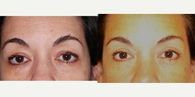 Eyelid Surgery before and after photo