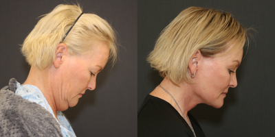 Eyelid Surgery before and after photo