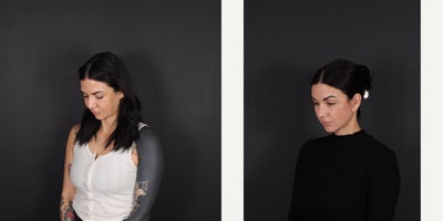 Eyelid Surgery before and after photo