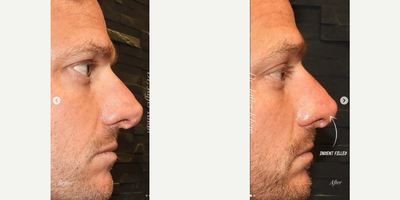 Rhinoplasty before and after photo