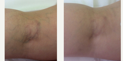 Sclerotherapy before and after photo