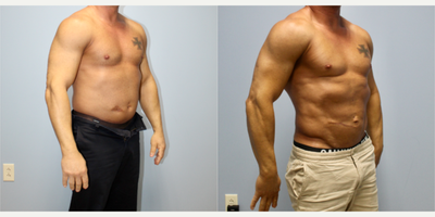 Vaser Liposuction before and after photo