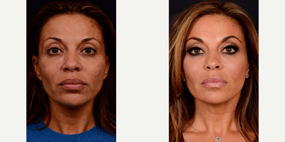 Eyelid Surgery before and after photo