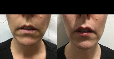 Juvederm before and after photo
