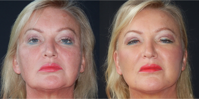 Mini Facelift before and after photo