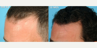 NeoGraft before and after photo