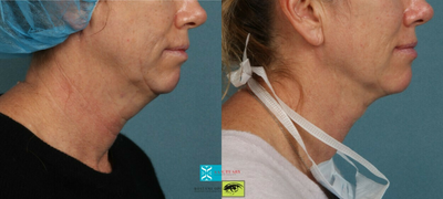 Nonsurgical Neck Lift before and after photo