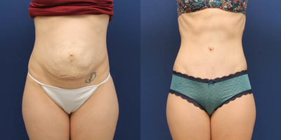 Tummy Tuck before and after photo