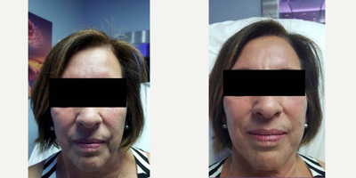 Dermal Fillers before and after photo