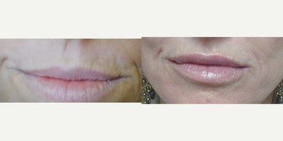 Lip Fillers before and after photo