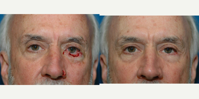 Mohs Surgery before and after photo
