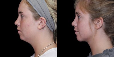 Chin Liposuction before and after photo