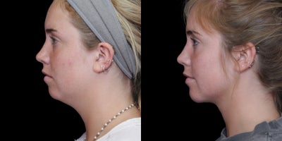 Chin Liposuction before and after photo