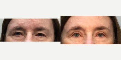 Eyelid Surgery before and after photo