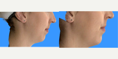 Juvederm before and after photo