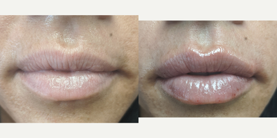 Lip Fillers before and after photo
