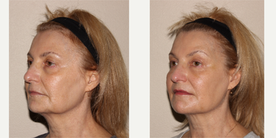 Liquid Facelift before and after photo