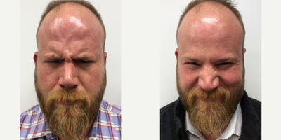 Botox before and after photo