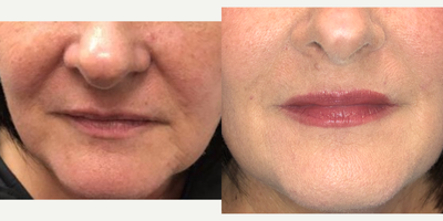 Dermal Fillers before and after photo
