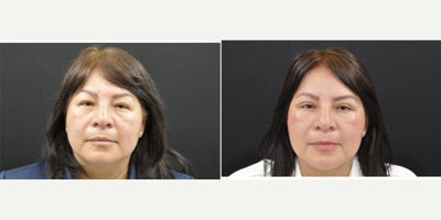 Eyelid Surgery before and after photo