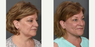 Facelift before and after photo