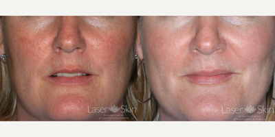 Fraxel Laser before and after photo