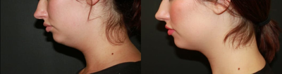 Kybella before and after photo