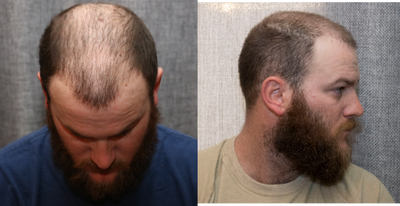 ARTAS Robotic Hair Transplant before and after photo