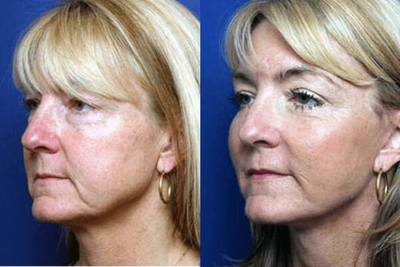 Cheek Lift before and after photo