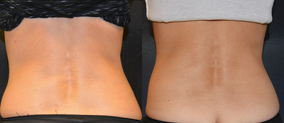 CoolSculpting before and after photo