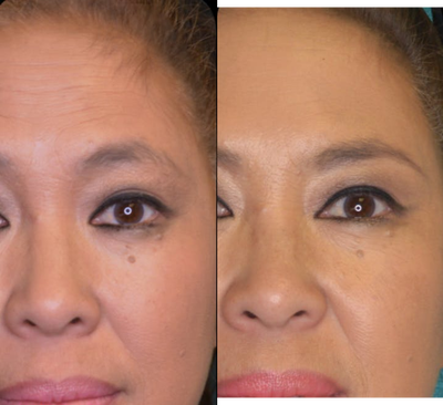 Dysport before and after photo