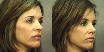 Rhinoplasty before and after photo