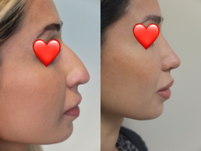 Rhinoplasty before and after photo