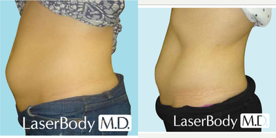 CoolSculpting before and after photo