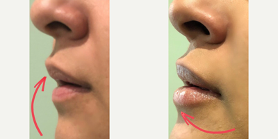 Juvederm before and after photo