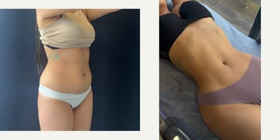 Liposculpture before and after photo