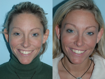 Botox before and after photo