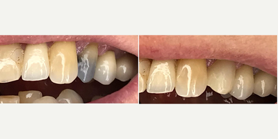 Dental Crown before and after photo