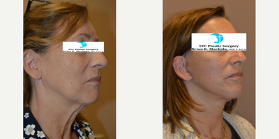 Facelift before and after photo