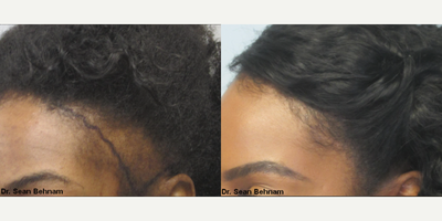 Hair Transplant before and after photo