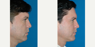 Neck Lift before and after photo
