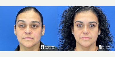 Botox before and after photo