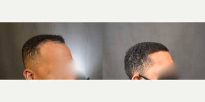 FUE Hair Transplant before and after photo