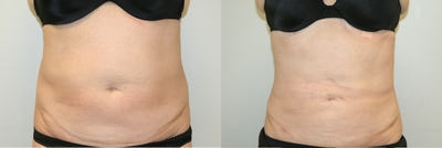 Smart Lipo before and after photo