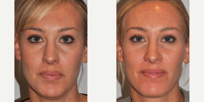 Dermal Fillers before and after photo