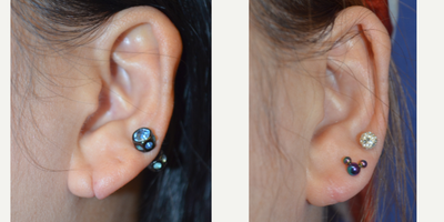 Earlobe Repair before and after photo