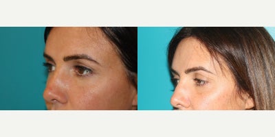 Eyelid Retraction Repair before and after photo