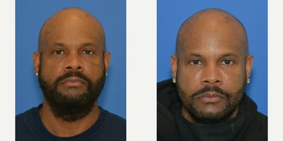 Eyelid Surgery before and after photo