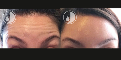 Botox before and after photo