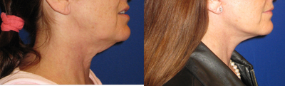 Neck Lift before and after photo